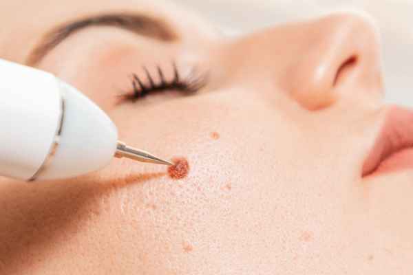 CryoPen: 5 Skin Concerns It May Be Used to Treat 3 What actually happens during a CryoPen treatment Worthing?
