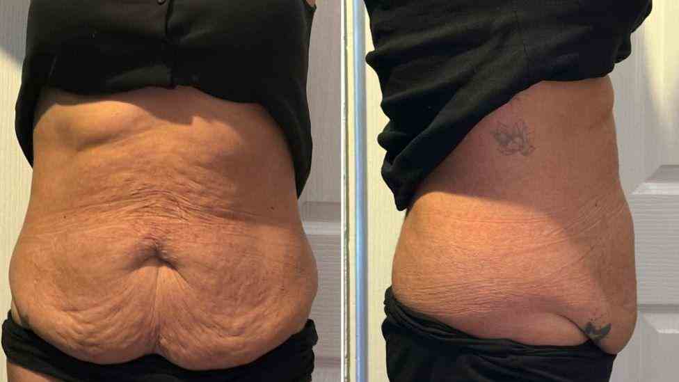 Lost the Weight but Not the Loose Skin? What You Should Know 1 Is It Definitely Loose Skin Worthing?